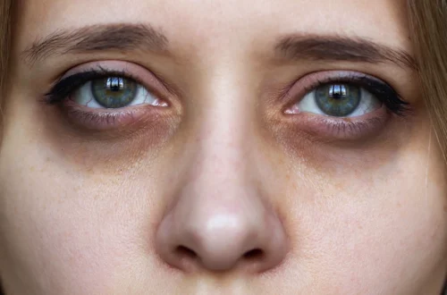 Causes of Dark Circles