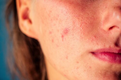 Ayurvedic Solution for Blemishes