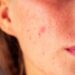 Ayurvedic Solution for Blemishes