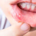 Mouth Ulcers