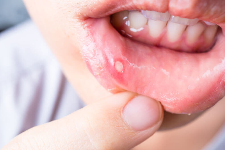 Mouth Ulcers